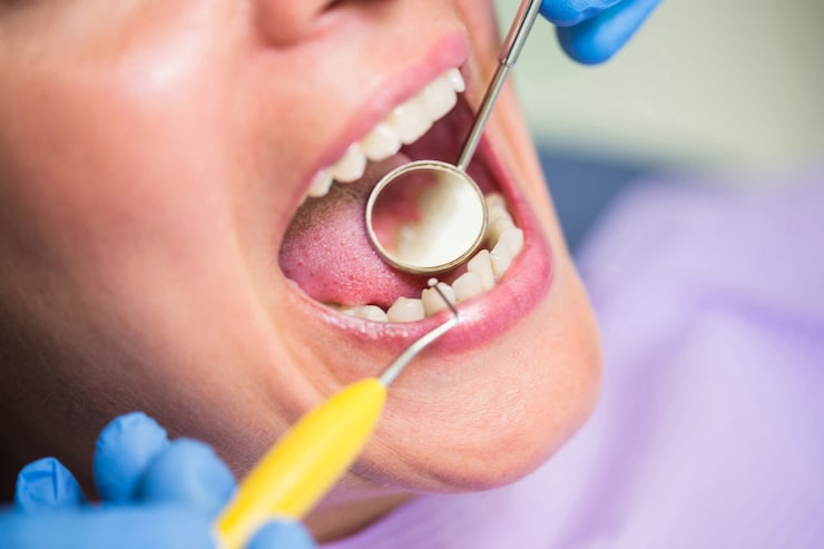 How Long Does a Cavity Dental Filling Procedure Take?